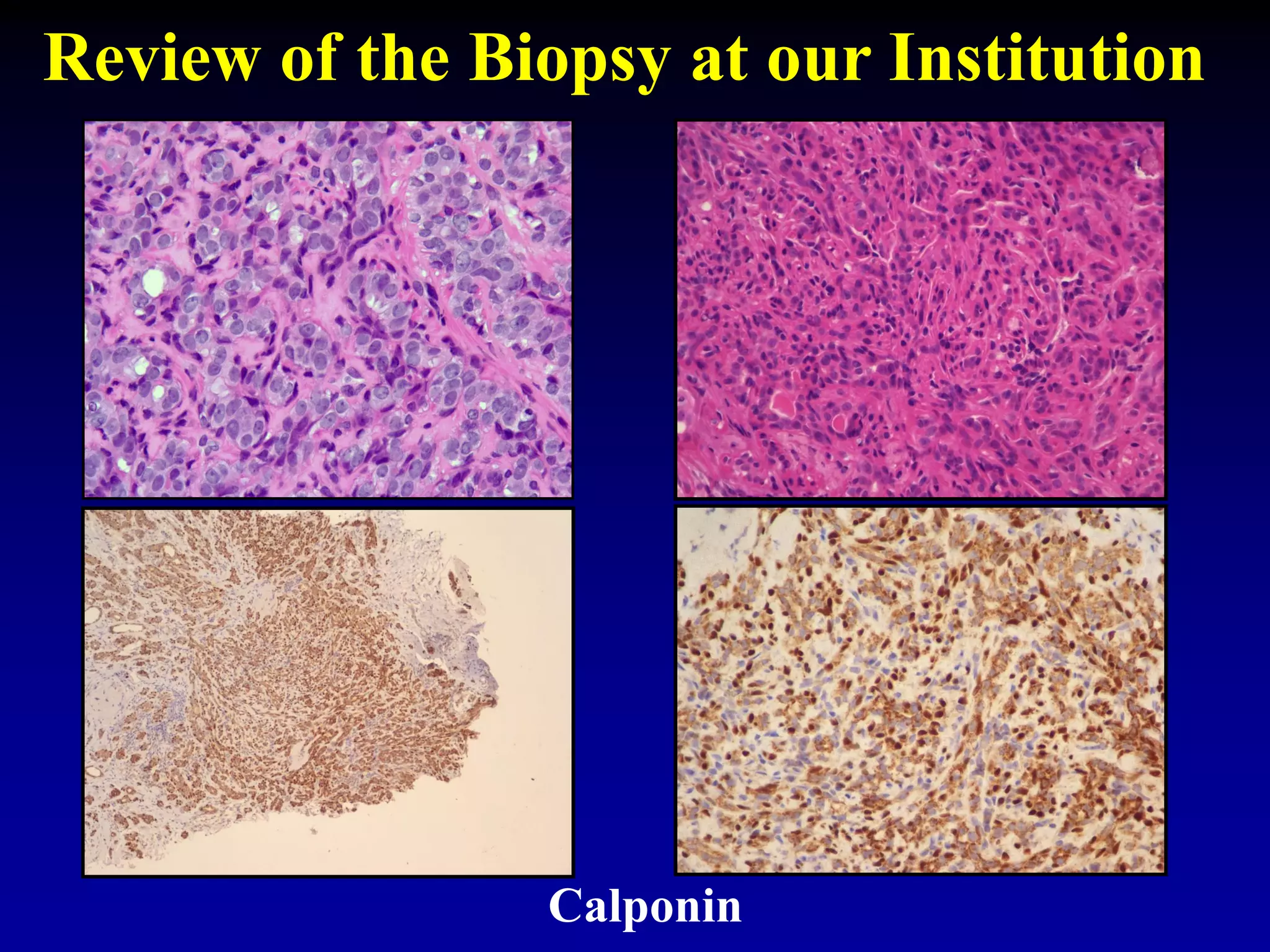 Calponin
Review of the Biopsy at our Institution
 