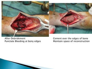 After Debridement
Punctate Bleeding at bony edges
Cement over the edges of bone
Maintain space of reconstruction
 
