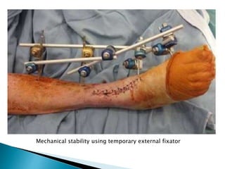 Mechanical stability using temporary external fixator
 