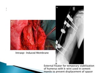 Intraop- Induced Membrane
External fixator for temporary stabilization
of humerus with k-wire used in cement
mantle to prevent displacement of spacer
 