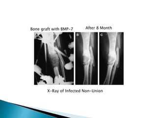 Bone graft with BMP-7 After 8 Month
X-Ray of Infected Non-Union
 