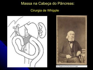 Massa na Cabeça do Pâncreas:
    Cirurgia de Whipple
 