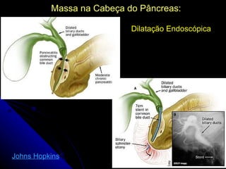 Massa na Cabeça do Pâncreas:

                           Dilatação Endoscópica




Johns Hopkins
 