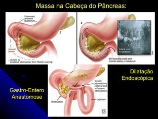 Massa na Cabeça do Pâncreas:




                                      Dilatação
                                   Endoscópica

Gastro-Entero
Anastomose
 