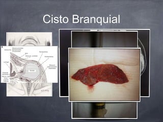 Cisto Branquial
 