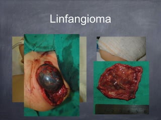 Linfangioma
 