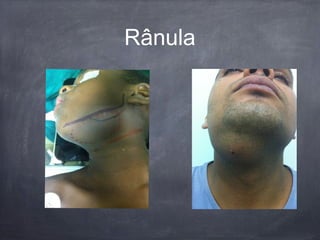 Rânula
 