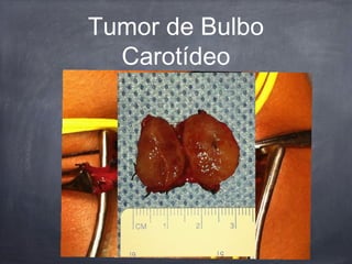 Tumor de Bulbo
Carotídeo
 