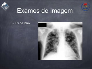 Exames de Imagem
Rx de tórax
 