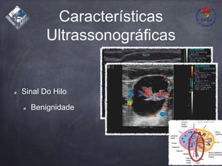 Características
Ultrassonográficas
Sinal Do Hilo
Benignidade
 