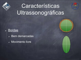 Características
Ultrassonográficas
Bordas
Bem demarcadas
Movimento livre
 