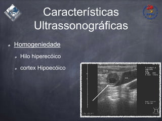 Características
Ultrassonográficas
Homogeniedade
Hilo hiperecóico
cortex Hipoecóico
 