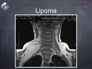 Lipoma
 