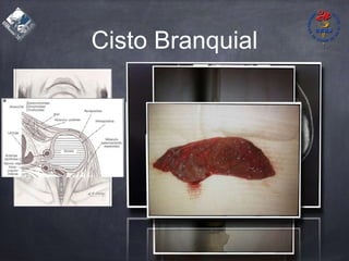 Cisto Branquial
 
