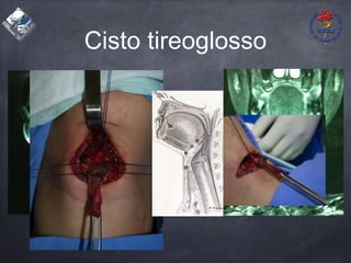 Cisto tireoglosso
 