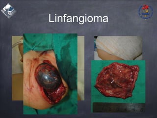 Linfangioma
 