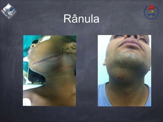 Rânula
 