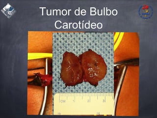 Tumor de Bulbo
Carotídeo
 