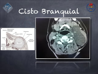 Cisto Branquial
 