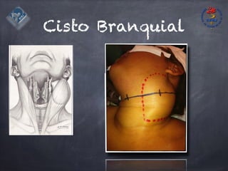 Cisto Branquial
 