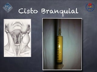 Cisto Branquial
 