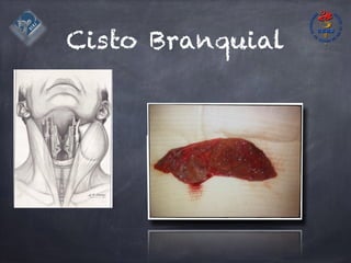 Cisto Branquial
 