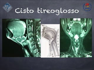 Cisto tireoglosso
 