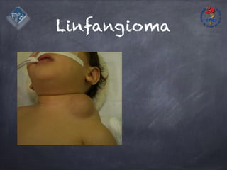 Linfangioma
 