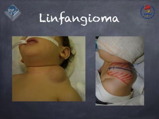 Linfangioma
 