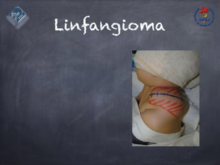 Linfangioma
 