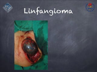 Linfangioma
 
