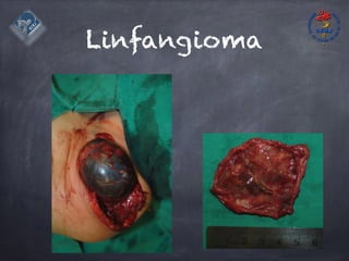Linfangioma
 