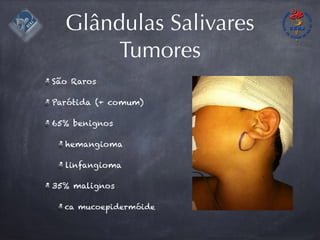 Glândulas Salivares
Tumores
São Raros
Parótida (+ comum)
65% benignos
hemangioma
linfangioma
35% malignos
ca mucoepidermóide
 