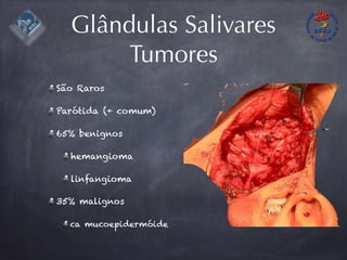 Glândulas Salivares
Tumores
São Raros
Parótida (+ comum)
65% benignos
hemangioma
linfangioma
35% malignos
ca mucoepidermóide
 