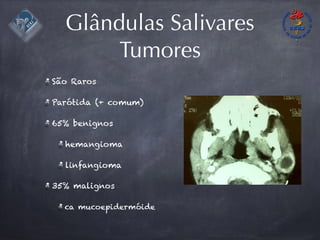 Glândulas Salivares
Tumores
São Raros
Parótida (+ comum)
65% benignos
hemangioma
linfangioma
35% malignos
ca mucoepidermóide
 