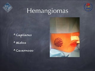 Hemangiomas
Capilares
Mistos
Cavernoso
 