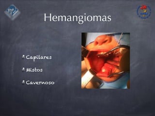 Hemangiomas
Capilares
Mistos
Cavernoso
 