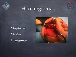 Hemangiomas
Capilares
Mistos
Cavernoso
 