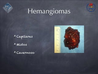 Hemangiomas
Capilares
Mistos
Cavernoso
 