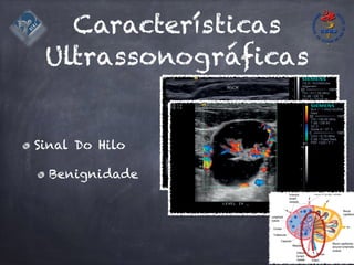 Características
Ultrassonográficas
Sinal Do Hilo
Benignidade
IISonographic
Fig.
A ro
the c
“hila
The a
ident
case,
main
struc
A cy
be f
carci
Fig.
This
of in
gene
musc
spine
 