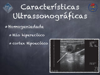 Características
Ultrassonográficas
Homogeniedade
Hilo hiperecóico
cortex Hipoecóico
 
