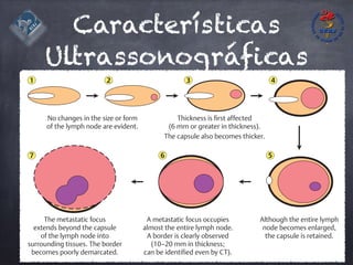 Características
Ultrassonográficas
No changes in the size or form
of the lymph node are evident.
Thickness is first affected
(6 mm or greater in thickness).
The capsule also becomes thicker.
Although the entire lymph
node becomes enlarged,
the capsule is retained.
A metastatic focus occupies
almost the entire lymph node.
A border is clearly observed
(10–20 mm in thickness;
can be identified even by CT).
The metastatic focus
extends beyond the capsule
of the lymph node into
surrounding tissues. The border
becomes poorly demarcated.
1 2 3
7 6 5
4
 