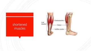 shortened
muscles
 