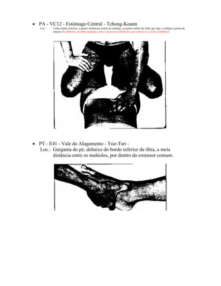 • PA - VC12 - Estômago Central - Tchong-Koann
Loc.: Linha média anterior, a quatro distâncias acima do umbigo, ou ponto médio da linha que liga o umbigo à ponta do
esterno.No abdome, na linha mediana, entre o processo xifóide do osso esterno e a cicatriz umbilical.
• PT - E41 - Vale do Alagamento - Tsie-Tsri -
Loc.: Garganta do pé, debaixo do bordo inferior da tíbia, a meia
distância entre os maléolos, por dentro do extensor comum.
 
