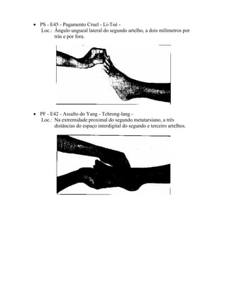• PS - E45 - Pagamento Cruel - Li-Toé -
Loc.: Ângulo ungueal lateral do segundo artelho, a dois milímetros por
trás e por fora.
• PF - E42 - Assalto do Yang - Tchrong-lang -
Loc.: Na extremidade proximal do segundo metatarsiano, a três
distâncias do espaço interdigital do segundo e terceiro artelhos.
 