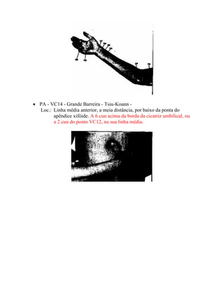 • PA - VC14 - Grande Barreira - Tsiu-Koann -
Loc.: Linha média anterior, a meia distância, por baixo da ponta do
apêndice xifóide. A 6 cun acima da borda da cicatriz umbilical, ou
a 2 cun do ponto VC12, na sua linha média.
 