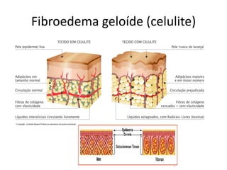 Fibroedema geloíde (celulite)
 