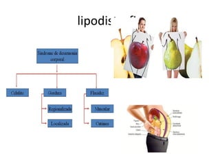 lipodistrofia
 