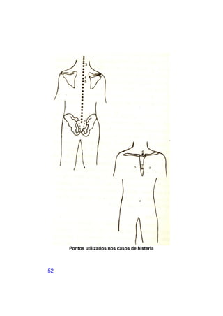 Pontos utilizados nos casos de histeria




52
 