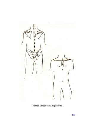 Pontos utilizados na taquicardia



                                   55
 